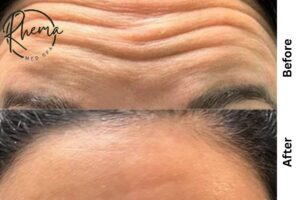 20 units of botox before and after