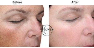 VI Chemical Peel Before and After