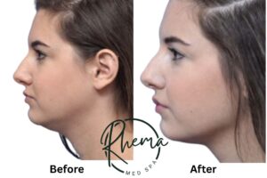 Kybella Before and Afte