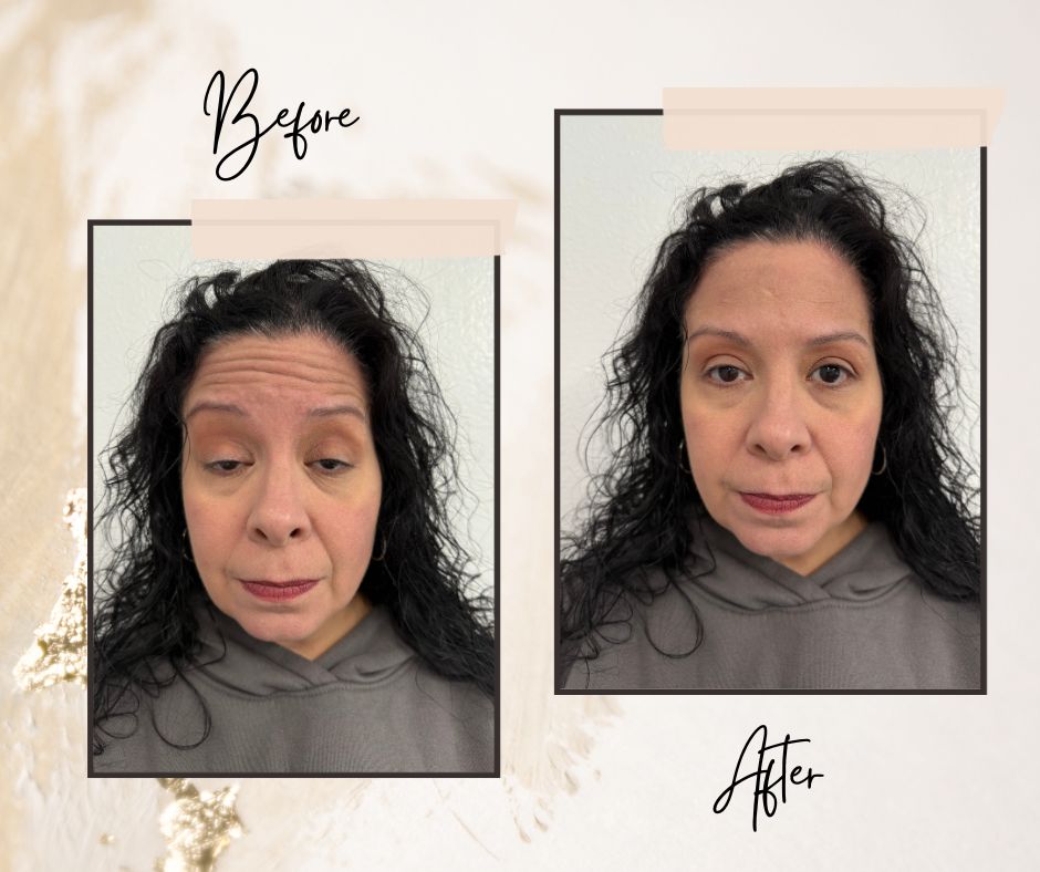 Botox Results: Before & After Photos